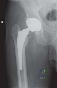 صورة طبية: الرقبة المعيارية Kinectiv® Stem لمفصل الورك الصناعي: حلول متطورة لنجاح جراحة استبدال مفصل الورك مع الأستاذ الدكتور محمد هطيف في صنعاء