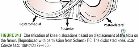Illustration of knee dislocation femorotibial - Dr. Mohammed Hutaif