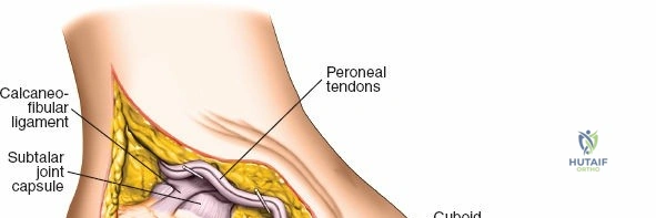 Extensile Lateral Approach to Calcaneal Fractures: Anatomy, Technique & Management