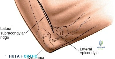 ما هي الكسور المستعرضة البسيطة؟ شرح كامل لأسبابها وأنواعها