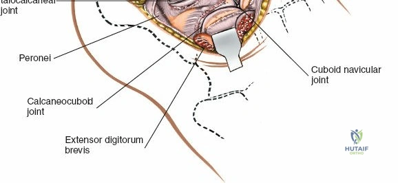Lateral Approach to the Hindfoot: Surgical Anatomy, Biomechanics, and Clinical Applications