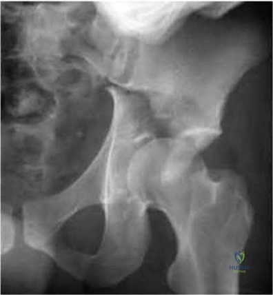 Operative Management of Peripheral Nerve Lesions: Lumbar Plexus and Median Nerve