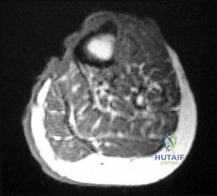Orthopedic Board Review: Bone Dysplasias, Cysts & Synovial Chondromatosis | Part 20