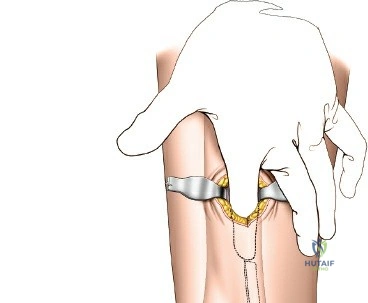 Illustration of distal tibia minimally - Dr. Mohammed Hutaif