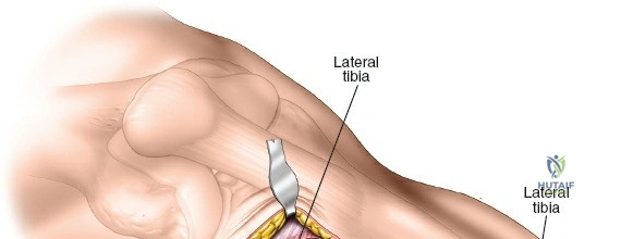 Illustration of line of the skin - Dr. Mohammed Hutaif