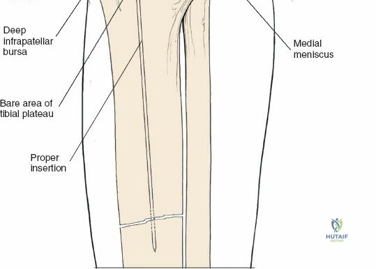 Illustration of approach for tibial - Dr. Mohammed Hutaif