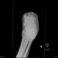 التهاب مفاصل اليد والمعصم: دليل شامل للعلاج والتعافي مع الأستاذ الدكتور محمد هطيف