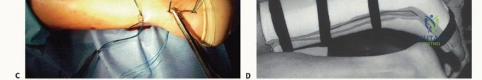 Nail Plate and Germinal Matrix Removal: The Quenu, Fowler, and Zadik Procedure