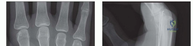 NAILS AND EXTERNAL FIXATORS