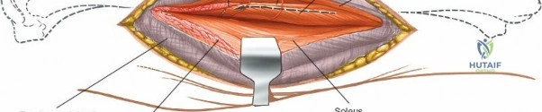 Illustration of williams wilkins pp - Dr. Mohammed Hutaif