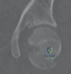 Illustration of base of the femoral - Dr. Mohammed Hutaif