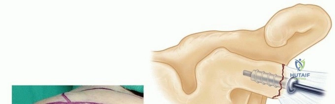 Illustration of scapular fractures open - Dr. Mohammed Hutaif