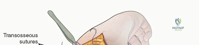 Illustration of fixation of pediatric - Dr. Mohammed Hutaif