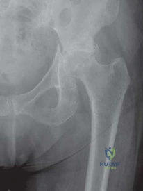 Open Repair of the Medial Patellofemoral Ligament and Vastus Medialis Obliquus Muscle