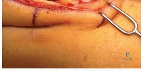 Aftercare Complications The wrist and hand