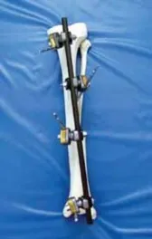 تفاصيل مرئية 35 - التثبيت الخارجي للقصبة: هكذا يتم وضع مسمارين لكسور معقدة