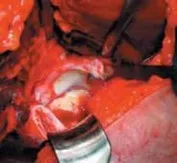 تفاصيل مرئية 28 - الفخذي المنعطف الانسي: ركيزة أمانك في خلع الورك الجراحي