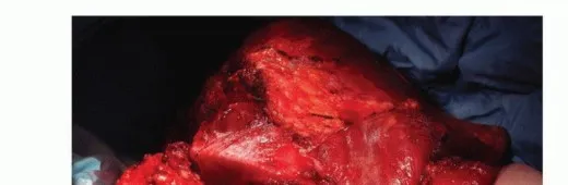 تفاصيل مرئية 24 - بتر الربع الأمامي: كل ما يجب أن تعرفه عن هذا الإجراء المعقد