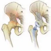 تفاصيل مرئية 10 - الخلاص من آلام سرطان العظام: استبدال مفصل الورك بالداني من الفخذ