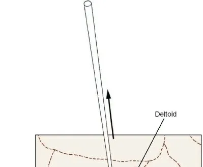 تفاصيل مرئية 3 - الوصول الأمامي الجانبي طفيف التوغل الي العضد دليل شامل