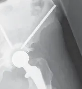 تفاصيل مرئية 5 - الخلاص من آلام سرطان العظام: استبدال مفصل الورك بالداني من الفخذ