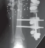 تفاصيل مرئية 56 - التثبيت الخارجي للقصبة: هكذا يتم وضع مسمارين لكسور معقدة