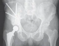 تفاصيل مرئية 11 - الخلاص من آلام سرطان العظام: استبدال مفصل الورك بالداني من الفخذ