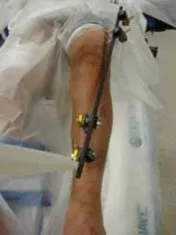 تفاصيل مرئية 60 - التثبيت الخارجي للقصبة: هكذا يتم وضع مسمارين لكسور معقدة