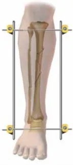 تفاصيل مرئية 65 - التثبيت الخارجي للقصبة: هكذا يتم وضع مسمارين لكسور معقدة