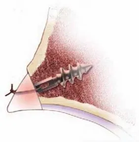 تفاصيل مرئية 24 - الفخذي المنعطف الانسي: ركيزة أمانك في خلع الورك الجراحي