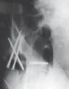 تفاصيل مرئية 28 - الخلاص من آلام سرطان العظام: استبدال مفصل الورك بالداني من الفخذ