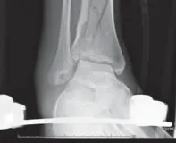 تفاصيل مرئية 22 - التثبيت الخارجي للقصبة: هكذا يتم وضع مسمارين لكسور معقدة