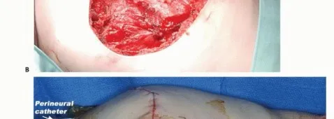 تفاصيل مرئية 42 - بتر الربع الأمامي: كل ما يجب أن تعرفه عن هذا الإجراء المعقد