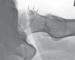 تفاصيل مرئية 8 - الفخذي المنعطف الانسي: ركيزة أمانك في خلع الورك الجراحي