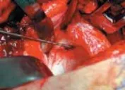 تفاصيل مرئية 22 - الفخذي المنعطف الانسي: ركيزة أمانك في خلع الورك الجراحي