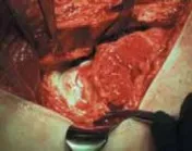 تفاصيل مرئية 23 - الفخذي المنعطف الانسي: ركيزة أمانك في خلع الورك الجراحي