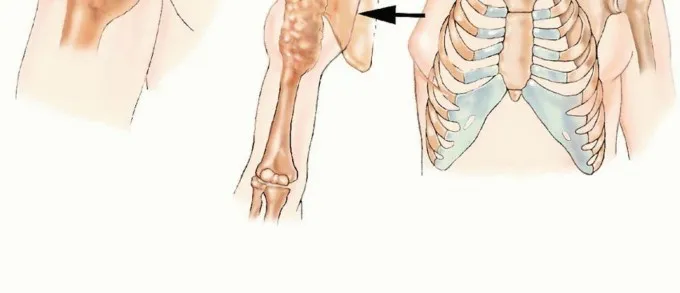 تفاصيل مرئية 3 - بتر الربع الأمامي: كل ما يجب أن تعرفه عن هذا الإجراء المعقد