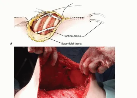 تفاصيل مرئية 41 - بتر الربع الأمامي: كل ما يجب أن تعرفه عن هذا الإجراء المعقد
