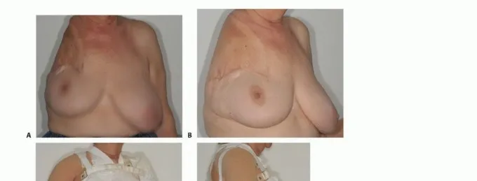 تفاصيل مرئية 45 - بتر الربع الأمامي: كل ما يجب أن تعرفه عن هذا الإجراء المعقد