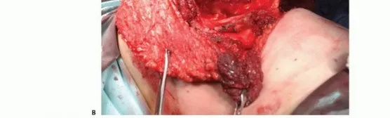 تفاصيل مرئية 36 - بتر الربع الأمامي: كل ما يجب أن تعرفه عن هذا الإجراء المعقد