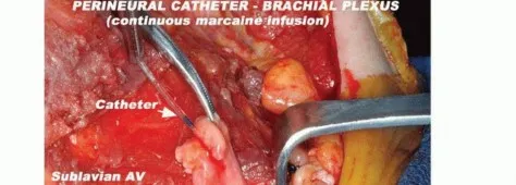 تفاصيل مرئية 39 - بتر الربع الأمامي: كل ما يجب أن تعرفه عن هذا الإجراء المعقد