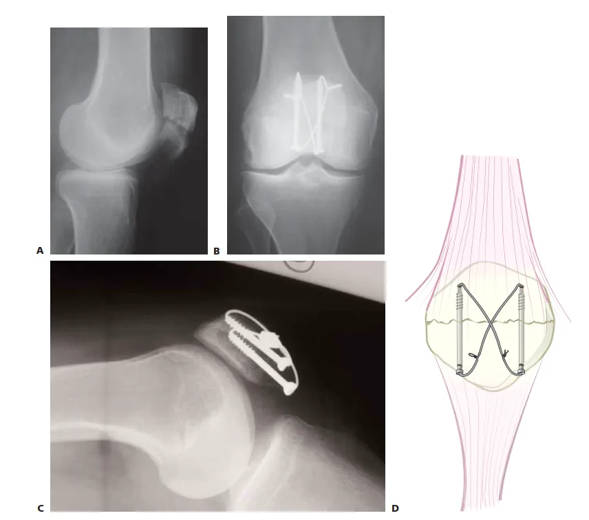 تفاصيل مرئية 6 - الرد المفتوح والتثبيت: مفتاحك لتعافي ناجح من كسور الرضفة.