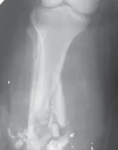 تفاصيل مرئية 53 - التثبيت الخارجي للقصبة: هكذا يتم وضع مسمارين لكسور معقدة