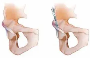 تفاصيل مرئية 26 - الفخذي المنعطف الانسي: ركيزة أمانك في خلع الورك الجراحي