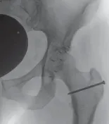 تفاصيل مرئية 33 - الفخذي المنعطف الانسي: ركيزة أمانك في خلع الورك الجراحي