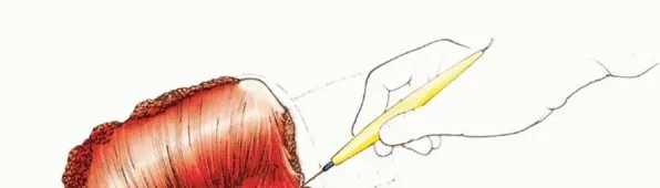 تفاصيل مرئية 29 - بتر الربع الأمامي: كل ما يجب أن تعرفه عن هذا الإجراء المعقد