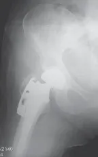 تفاصيل مرئية 19 - الخلاص من آلام سرطان العظام: استبدال مفصل الورك بالداني من الفخذ