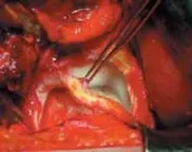 تفاصيل مرئية 27 - الفخذي المنعطف الانسي: ركيزة أمانك في خلع الورك الجراحي