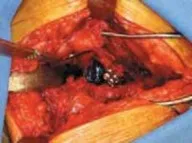 تفاصيل مرئية 26 - الخلاص من آلام سرطان العظام: استبدال مفصل الورك بالداني من الفخذ