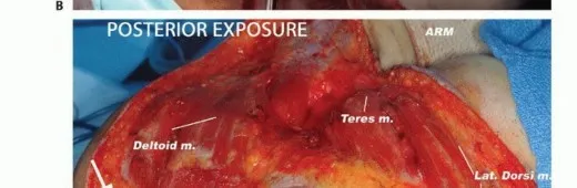 تفاصيل مرئية 26 - بتر الربع الأمامي: كل ما يجب أن تعرفه عن هذا الإجراء المعقد